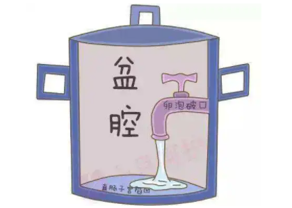 盆腔积液是怎么回事？白带91香蕉视频色厂家提醒早了解早预防