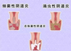 全自动阴道分泌物香蕉视频下载地址厂家提醒您还在拖延吗，还在等阴道炎自愈吗？