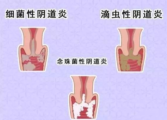 全自动阴道分泌物香蕉视频下载地址厂家提醒您还在拖延吗，还在等阴道炎自愈吗？